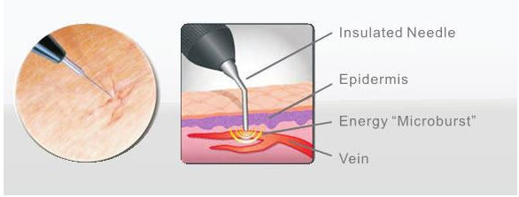 Segera hasil spider vein removal varises mesin perawatan laser / instrumen bedah vaskular